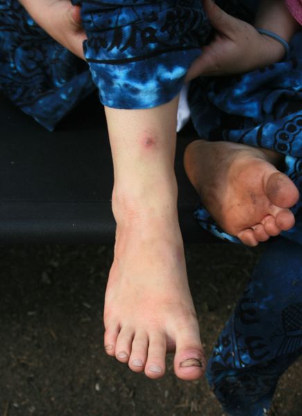 Infected Ankle. Photo by Dawn Ballou, Pinedale Online.