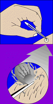 Use tweezers to remove a tick. (USFDA graphic)